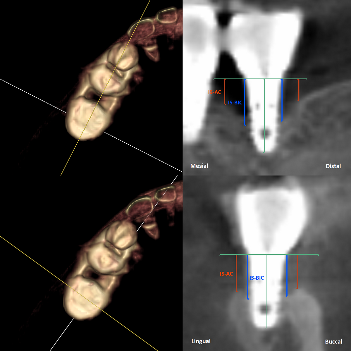 CBCT measurement method: implant shoulder to alveolar crest and to first bone-to-implant contact